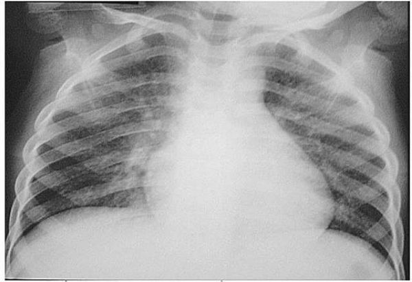 Viêm phổi do sặc dầu