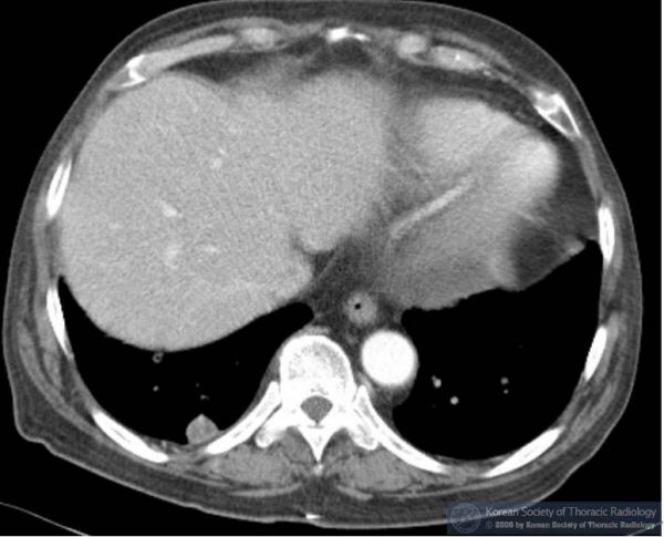 Viêm phổi pneumocystis ở bệnh AIDS