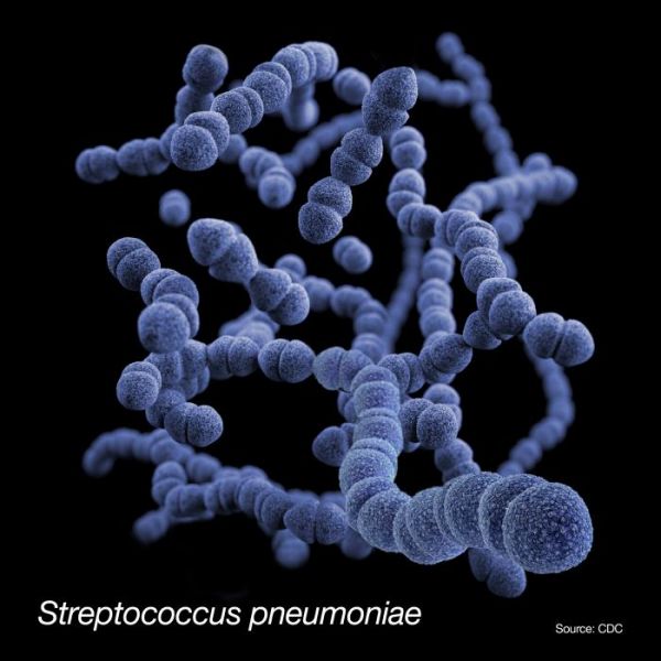 Viêm phổi thùy do Streptococcus pneumoniae