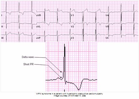 Wolff Parkinson White trên điện tâm đồ