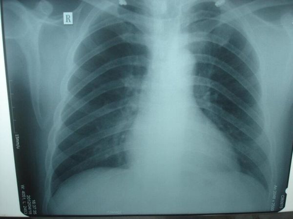 X quang ngực: ý nghĩa lâm sàng giá trị kết quả