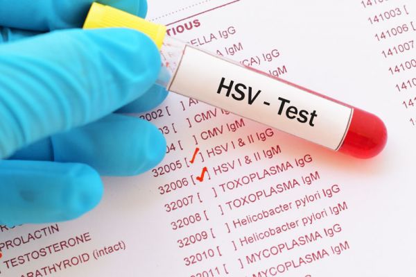 Xét nghiệm Herpes: ý nghĩa lâm sàng kết quả xét nghiệm