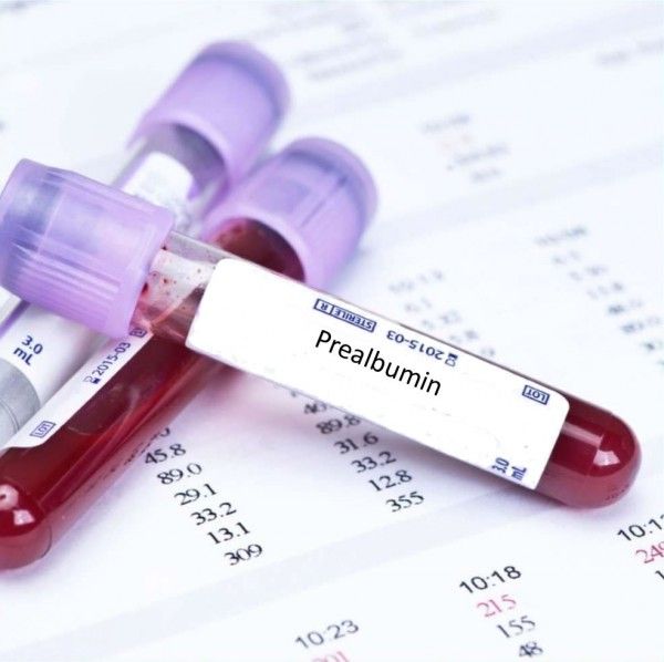 Xét nghiệm Prealbumin máu: ý nghĩa lâm sàng kết quả xét nghiệm