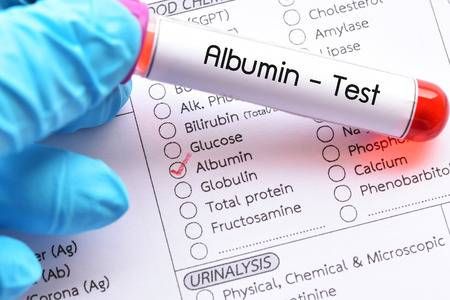 Xét nghiệm protein nước tiểu (Albumin): ý nghĩa lâm sàng chỉ số xét nghiệm