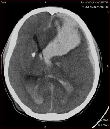 Xuất huyết não và não thất