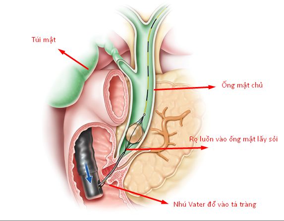 Nội soi đường mật ngược dòng (ERCP): ý nghĩa lâm sàng chỉ số kết quả