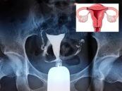 Chụp buồng tử cung vòi trứng cản quang (hysterosalpingogram): ý nghĩa lâm sàng giá trị kết quả