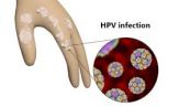 Papillomavirus (HPV): ý nghĩa lâm sàng chỉ số xét nghiệm
