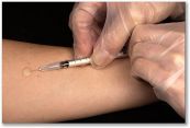 Phản ứng mantoux: xét nghiệm phản ứng da tuberculin