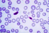 Phết máu dày và mỏng cho bệnh sốt rét: ý nghĩa lâm sàng kết quả xét nghiệm