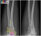 X quang chi: ý nghĩa lâm sàng giá trị kết quả