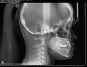 X quang mặt: ý nghĩa lâm sàng giá trị kết quả