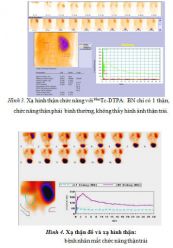 Xạ hình thận: ý nghĩa lâm sàng giá trị kết quả