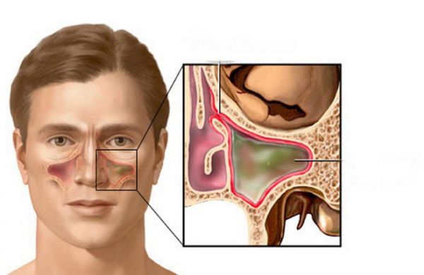 Chọc hút xoang viêm: xác định vi khuẩn, vi rút, hoặc nấm