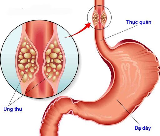 Kiểm tra thực quản: ý nghĩa lâm sàng giá trị kết quả