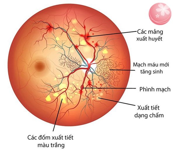 Soi đáy mắt: ý nghĩa lâm sàng giá trị kết quả