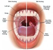 Nuôi cấy cổ họng: ý nghĩa lâm sàng kết quả nuôi cấy