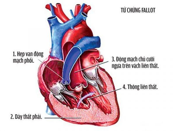 Bệnh tim bẩm sinh - triệu chứng, nguyên nhân và cách điều trị