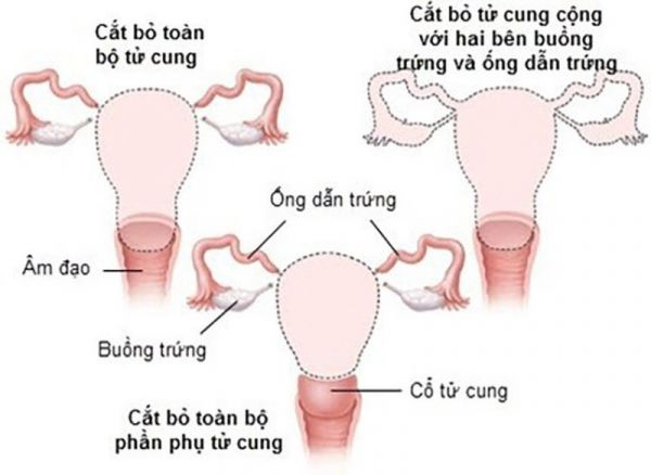 Cắt bỏ tử cung