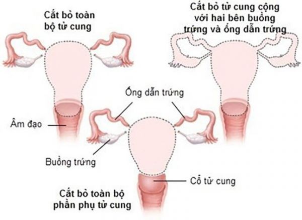 Cắt bỏ tử cung