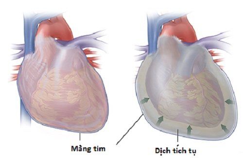 Bệnh chèn ép tim cấp tính - triệu chứng, nguyên nhân và cách điều trị