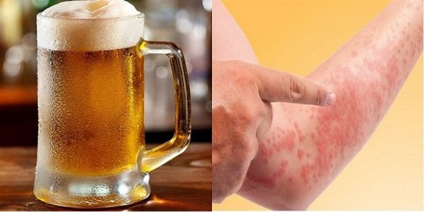 Bệnh dị ứng bia - triệu chứng, nguyên nhân và cách điều trị