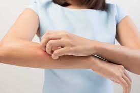 Bệnh dị ứng cây sơn độc - triệu chứng, nguyên nhân và cách điều trị