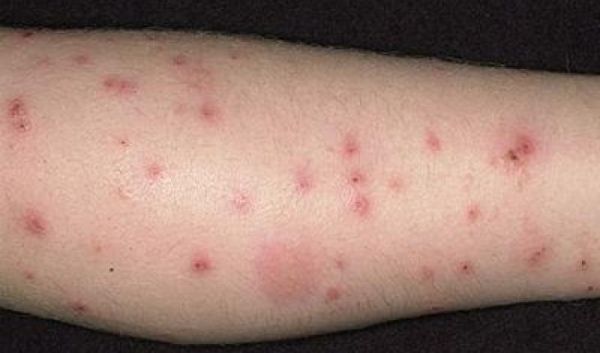 Bệnh dị ứng do côn trùng đốt - triệu chứng, nguyên nhân và cách điều trị