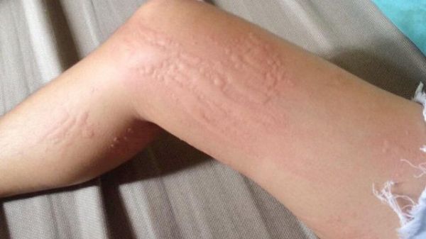 Bệnh dị ứng theo mùa - triệu chứng, nguyên nhân và cách điều trị