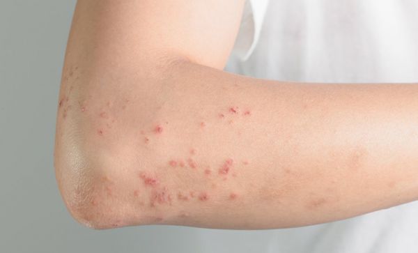 Bệnh dị ứng - triệu chứng, nguyên nhân và cách điều trị