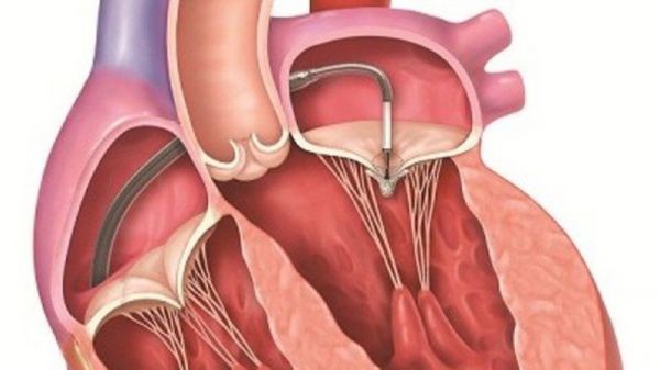 Bệnh hở van tim ba lá - triệu chứng, nguyên nhân và cách điều trị