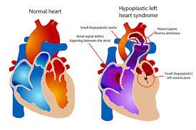 Hội chứng thiểu sản tim trái - Triệu chứng, nguyên nhân và cách điều trị