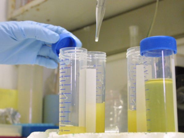 Nuôi cấy nước tiểu: ý nghĩa lâm sàng kết quả xét nghiệm