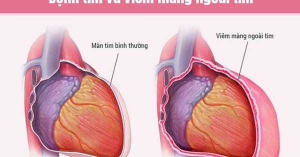 Bệnh viêm màng ngoài tim - Triệu chứng, nguyên nhân và cách điều trị