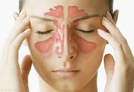 Bệnh viêm mũi dị ứng - Triệu chứng, nguyên nhân và cách điều trị