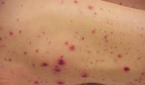 Bệnh xuất huyết giảm tiểu cầu miễn dịch - Triệu chứng, nguyên nhân và cách điều trị