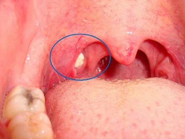 Bệnh sỏi amidan - Triệu chứng, nguyên nhân và cách điều trị