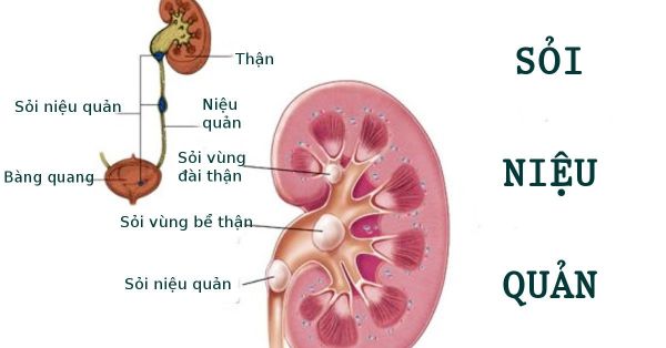 Bệnh sỏi niệu quản - Triệu chứng, nguyên nhân và cách điều trị