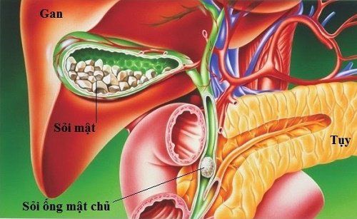 Bệnh sỏi ống mật chủ - Triệu chứng, nguyên nhân và cách điều trị
