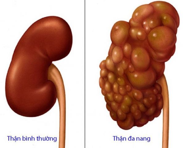 Bệnh thận đa nang - Triệu chứng, nguyên nhân và cách điều trị