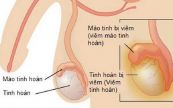 Bệnh viêm mào tinh hoàn - Triệu chứng, nguyên nhân và cách điều trị