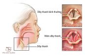 Bệnh viêm thanh quản - Triệu chứng, nguyên nhân và cách điều trị