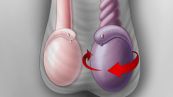 Bệnh xoắn tinh hoàn - Triệu chứng, nguyên nhân và cách điều trị