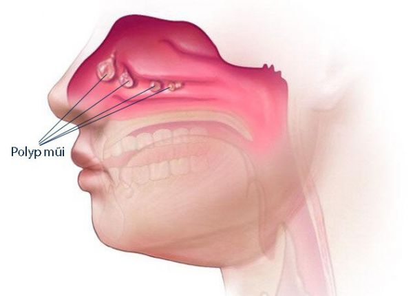 Bệnh polyp mũi - Triệu chứng, nguyên nhân và cách điều trị