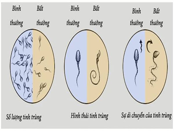 Bệnh ít tinh trùng - triệu chứng, nguyên nhân và cách điều trị