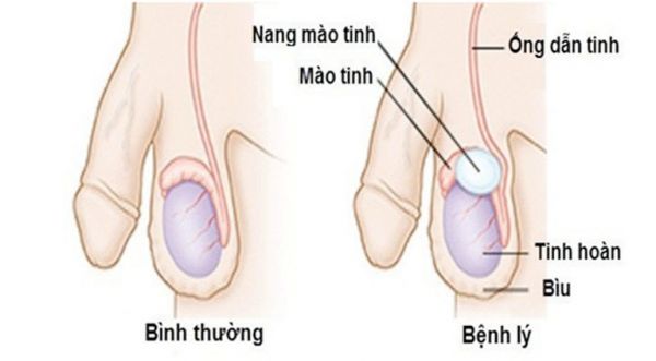 Bệnh vêm mào tinh hoàn và tinh hoàn - Triệu chứng, nguyên nhân và cách điều trị