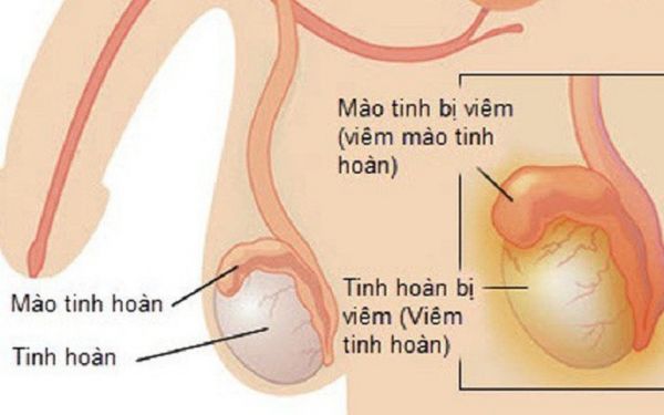 Bệnh viêm mào tinh hoàn - Triệu chứng, nguyên nhân và cách điều trị