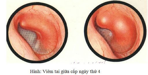 Bệnh viêm tai giữa cấp tính - Triệu chứng, nguyên nhân và cách điều trị