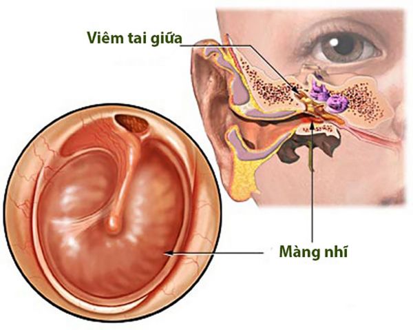 Bệnh viêm tai giữa - Triệu chứng, nguyên nhân và cách điều trị
