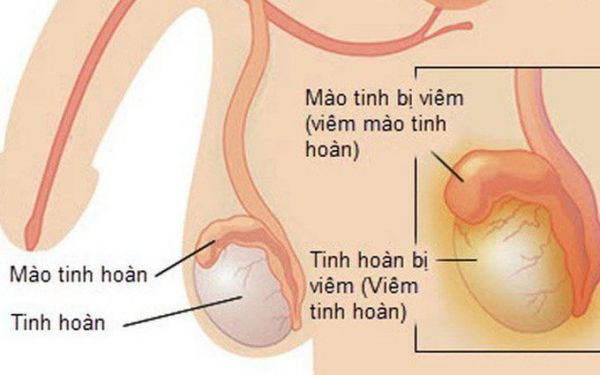 Bệnh viêm tinh hoàn - Triệu chứng, nguyên nhân và cách điều trị